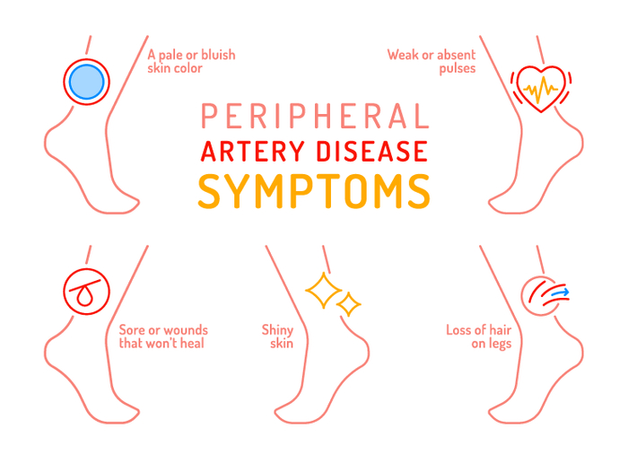Southern-Kentucky-Vascular-PAD-symptoms.jpg