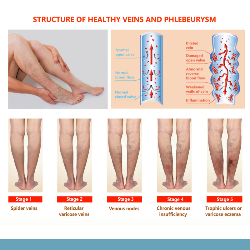 Varicose Vein Treatment - Contact A Vascular Surgeon - Southern