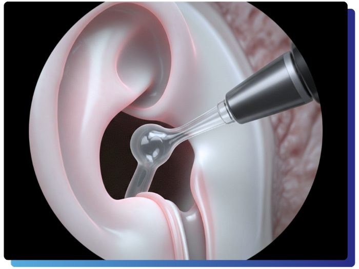 Eustachian Tube Balloon Dilation - 1.png