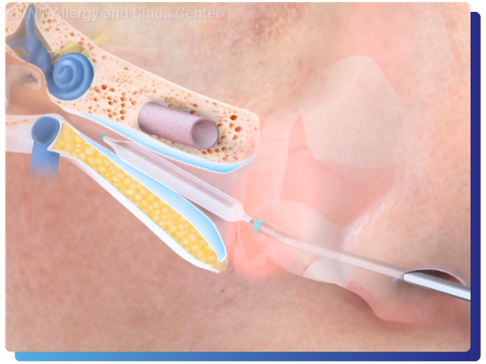 Eustachian Tube Balloon Dilation - 2.png
