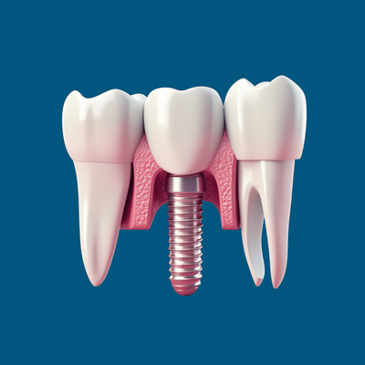 dental implant.png