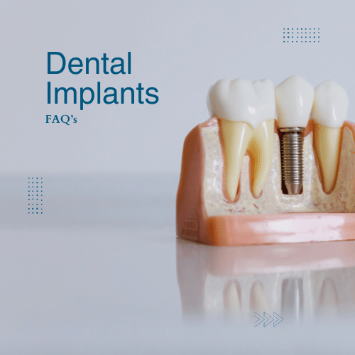 Dental Implants FAQ.png