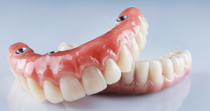 All-on-four dental implants and dentures
