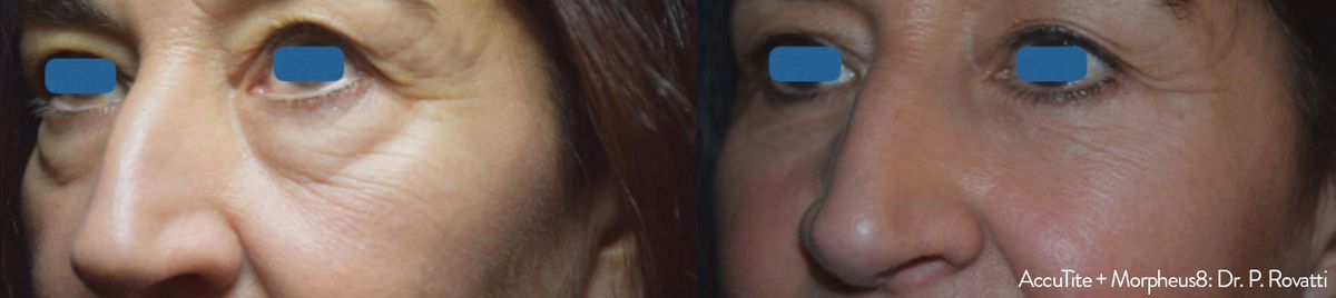accutite-morpheus8-before-after-dr-p-rovatti-preview-1.jpg