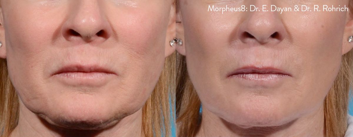 morpheus8-before-after-dr-e-dayan-dr-r-rohrich-preview-1.jpg