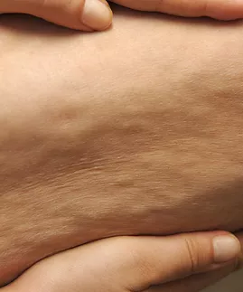 Image of cellulite