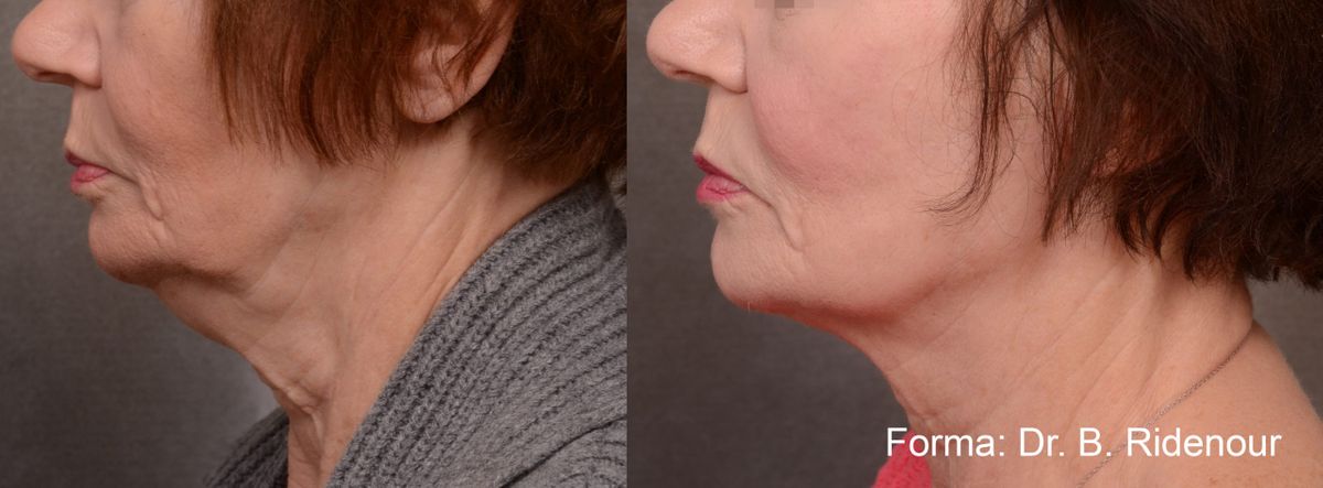forma-before-after-dr-b-ridenour-preview-1.jpg