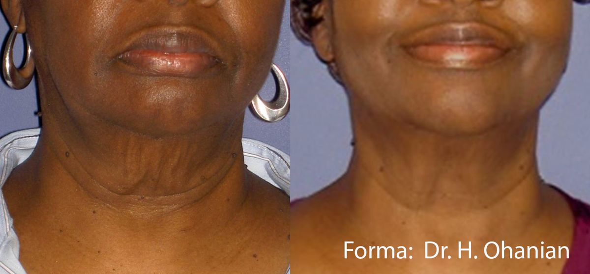 forma-before-after-dr-h-ohanian-preview-3.jpg