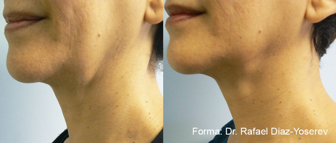 forma-before-after-dr-r-diaz-yoserev-preview-1.jpg