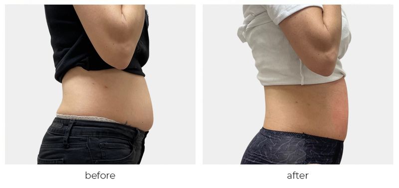 Before & After - WAYSLIM & SKIN - WaySlim and Skin