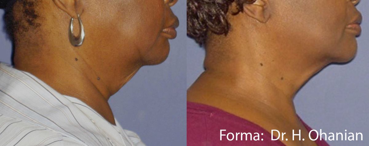forma-before-after-dr-h-ohanian-preview-1.jpg
