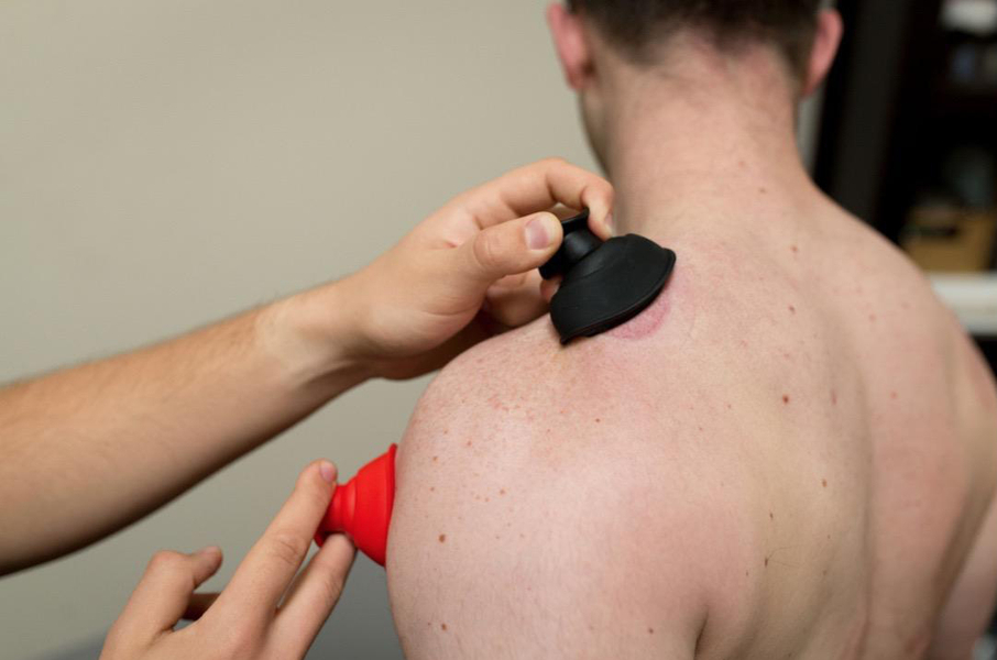 Cupping on shoulder