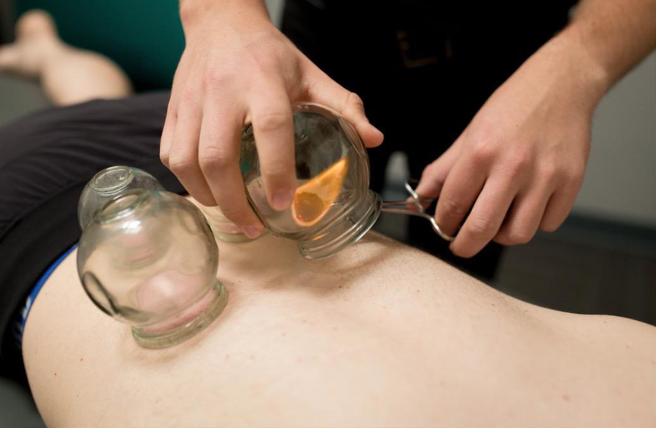 Cupping