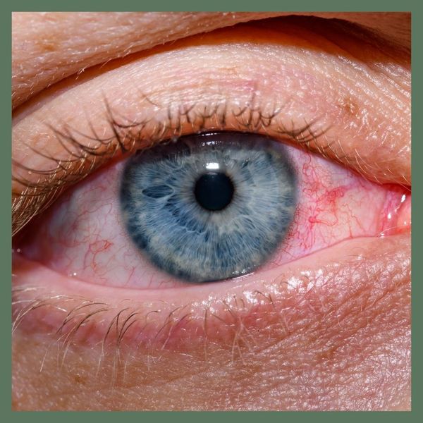 Exploring Common Symptoms and Signs that May Indicate the Need for Medical Eye Care4.jpg