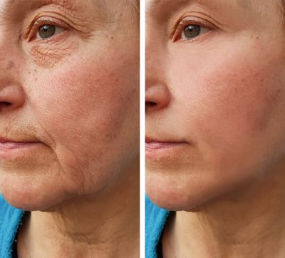 before-after-side-face.jpeg