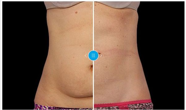 coolsculpting-before-and-after-pictures.jpg