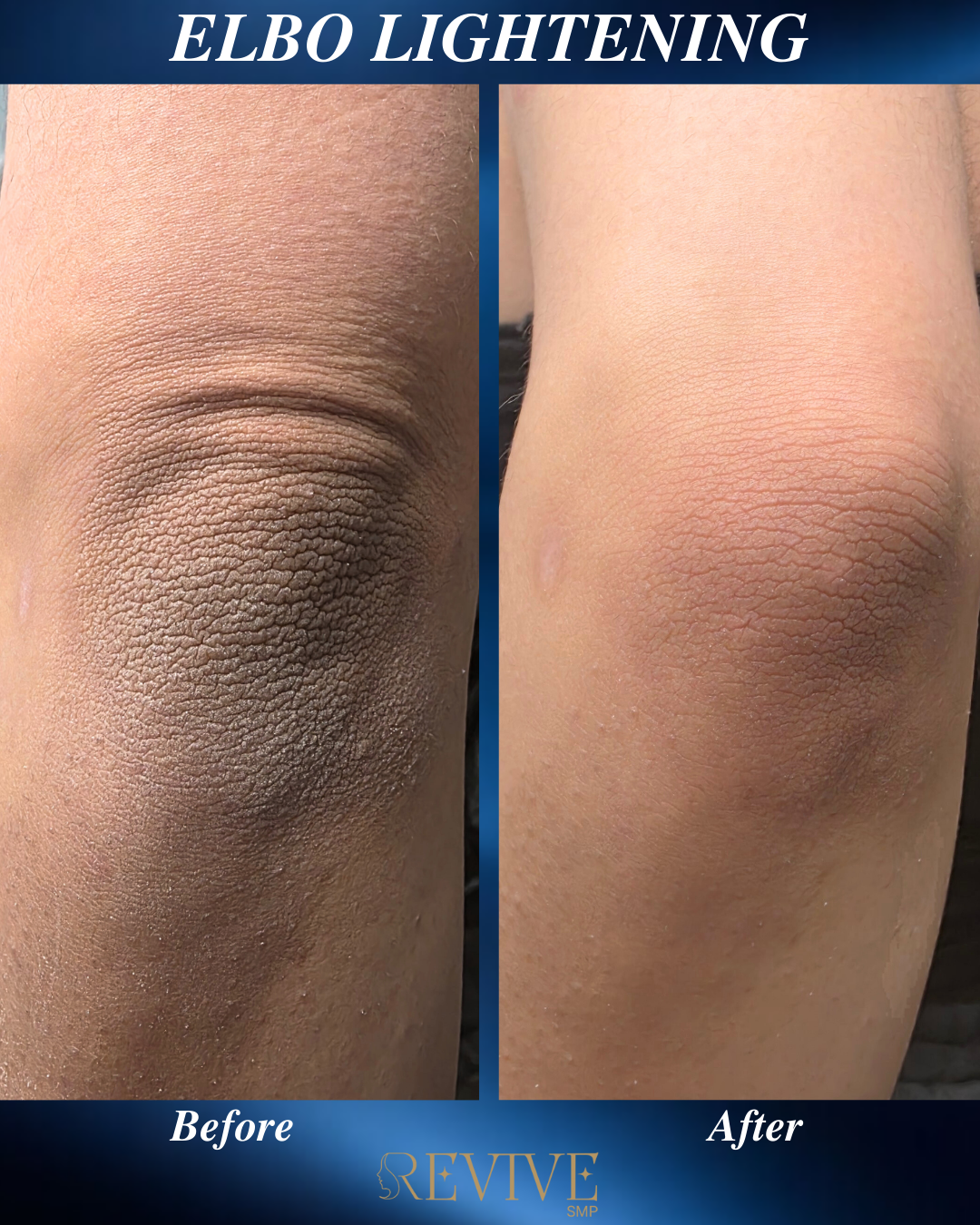 Inkless Stretch Mark Camouflage.png