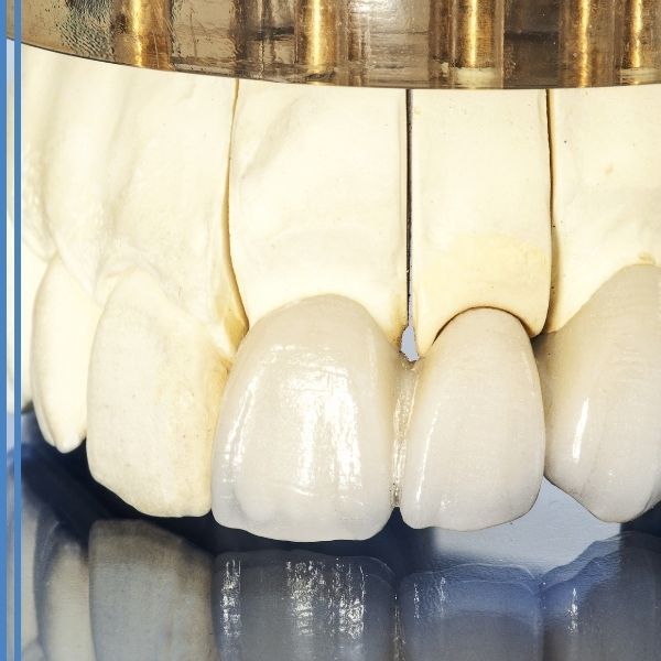 Dental bridges