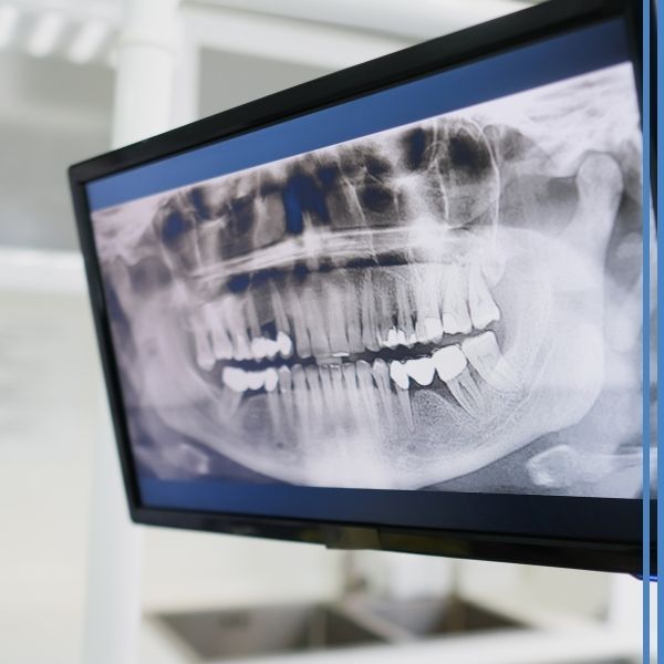 Dental xrays on a monitor