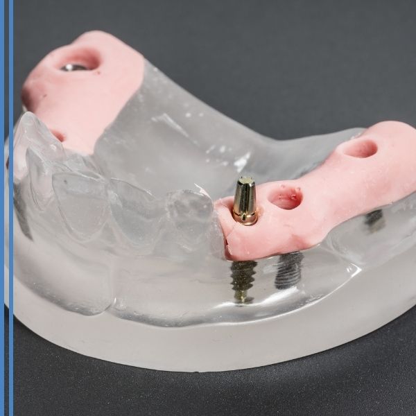 The hardware for dental bridges being installed