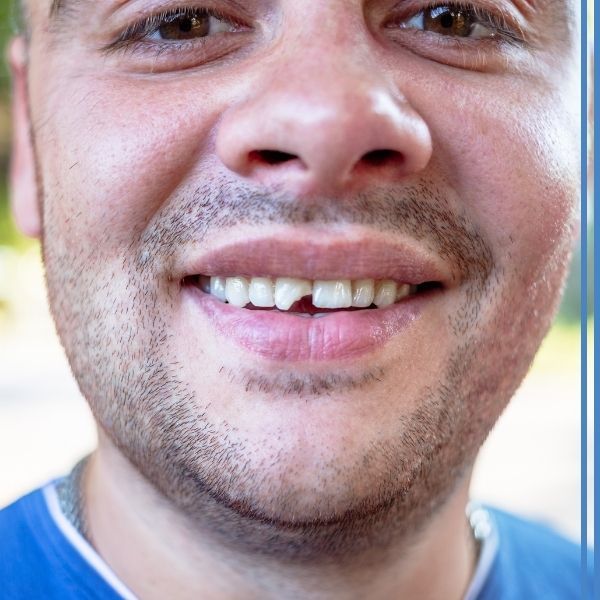 A close up of a man's smile with a chipped tooth