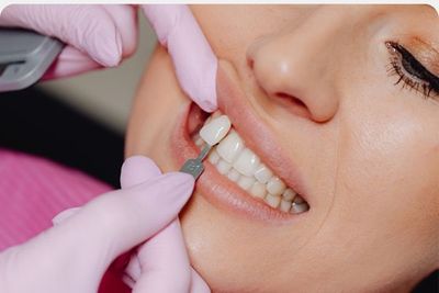 A dentist installing veneers
