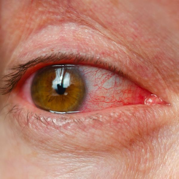 red irritated eye