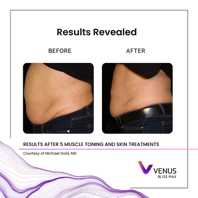 BlissMAX - 5 ems Michael Gold, MD.png