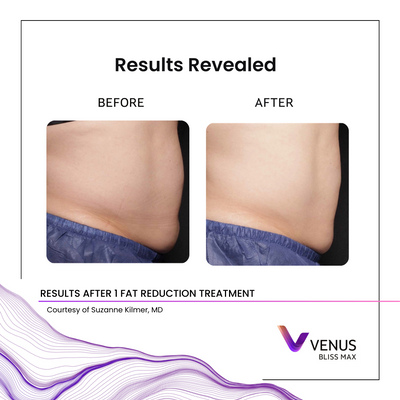 BlissMAX - 1 laser  .png