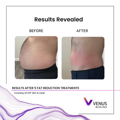 BlissMAX - LASER MOC Health & Beauty.png