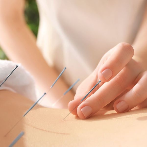 Image of acupuncture