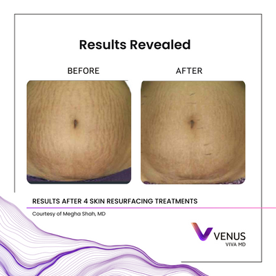 VivaMD 160-pin MeghaShah_Abdomen_4Tx.png