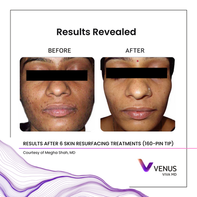 VivaMD 160-pin MeghaShah_Face_6Tx.png