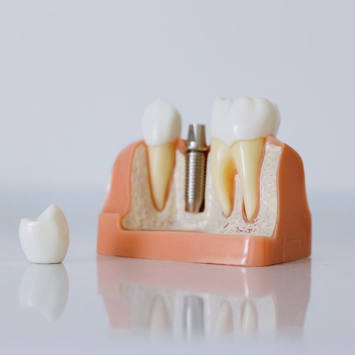 The Step-by-Step Process of Getting Dental Implants - 2.png