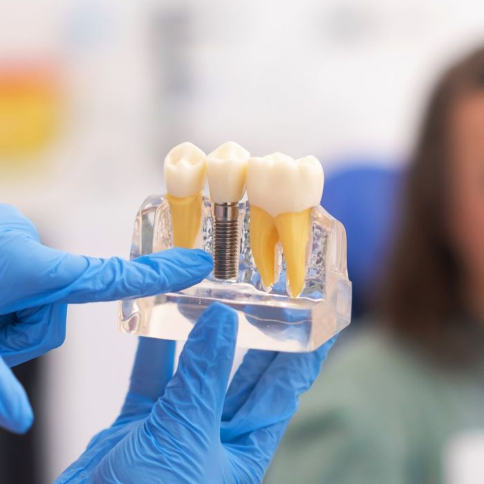 Close up of dental implants Close up of dental implants