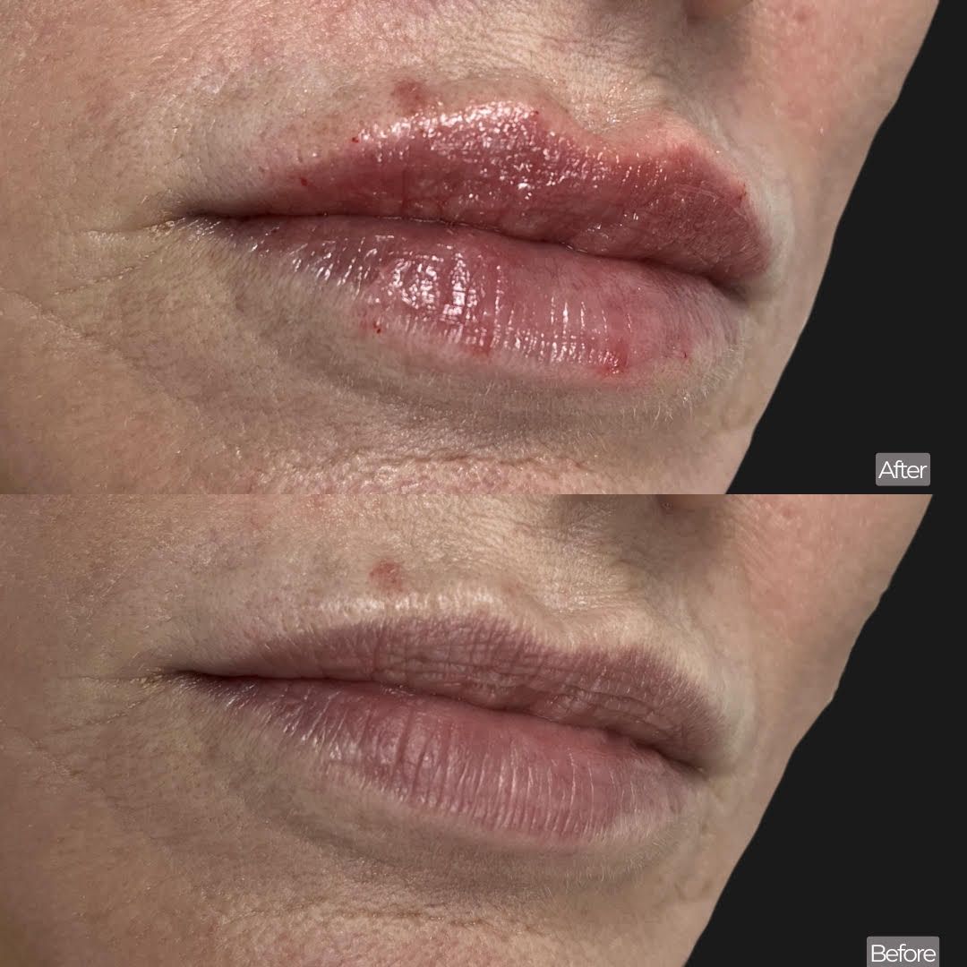 Natural lip filler results at she aesthetics in klein, spring, the woodlands, cypress and houston tx Natural lip filler results at she aesthetics in klein, spring, the woodlands, cypress and houston tx