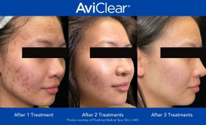 AviClear before and after