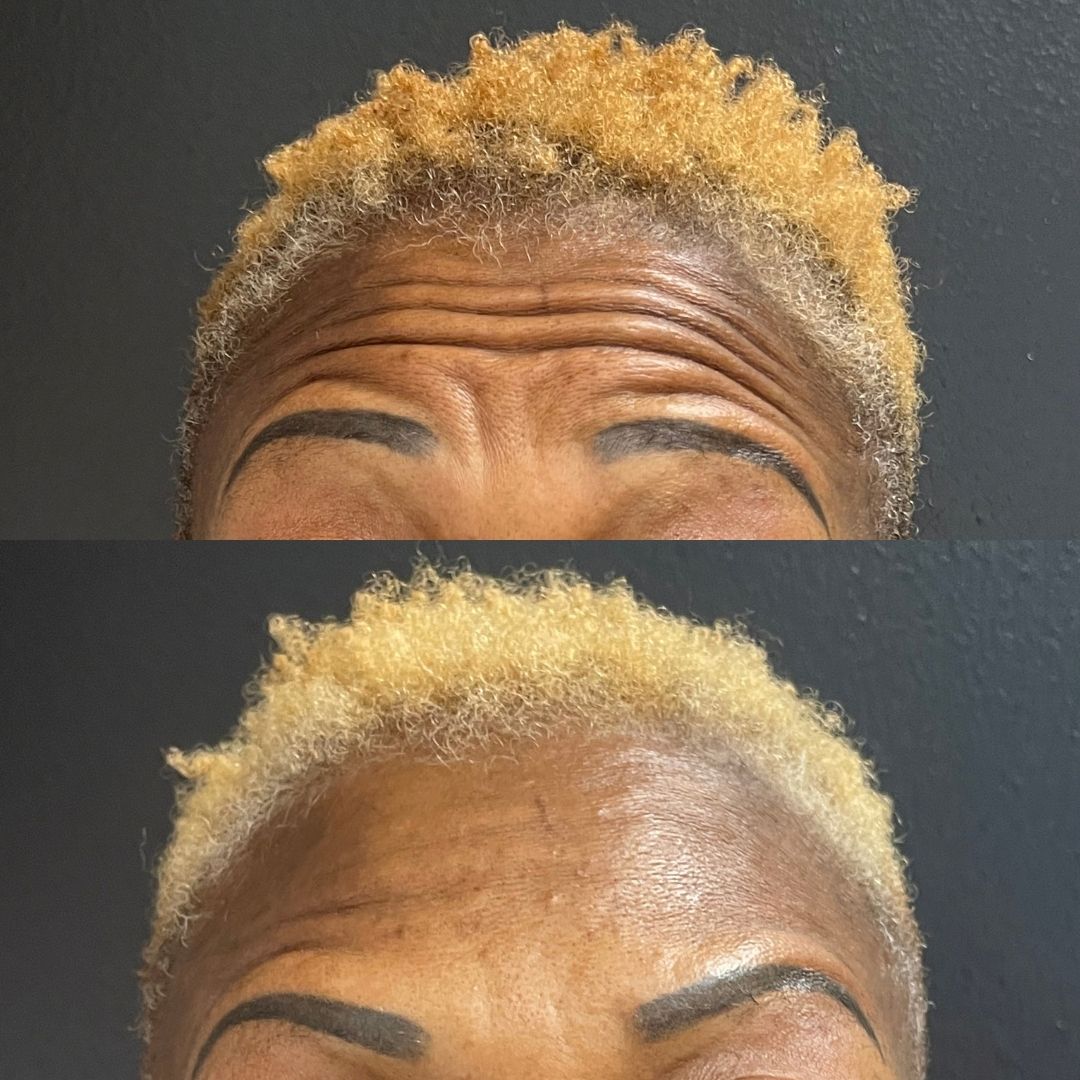 Smooth and relax Wrinkle using botox at she aesthetics in spring, klein, cypress, houston, tx Smooth and relax Wrinkle using botox at she aesthetics in spring, klein, cypress, houston, tx