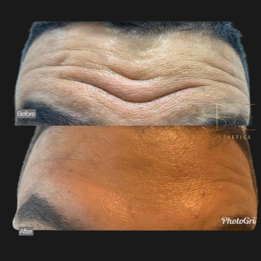 Smooth wrinkles with botox at she aesthetics in klein, spring, the woodlands, cypress tx Smooth wrinkles with botox at she aesthetics in klein, spring, the woodlands, cypress tx