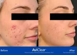 AviClear before and after