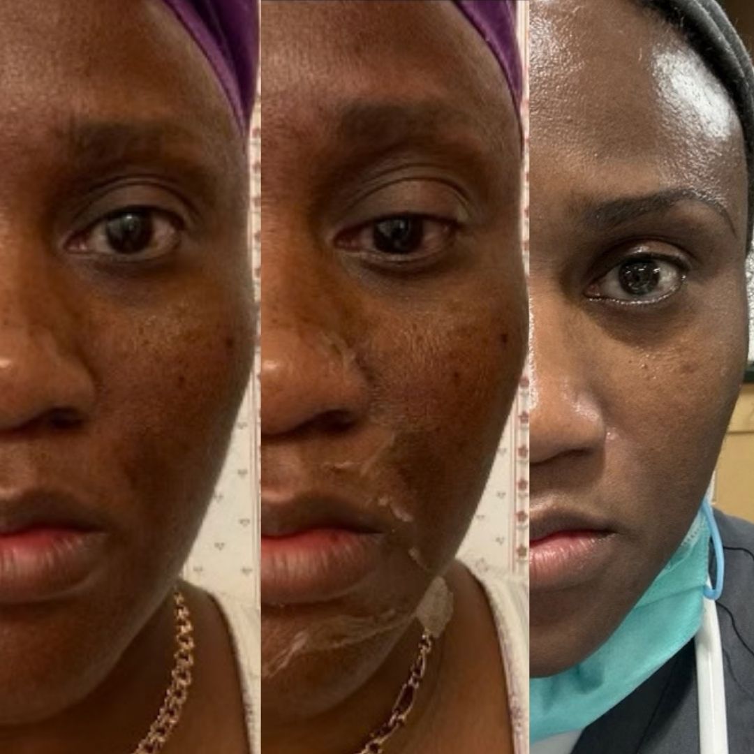 Chemical peel klein tx spring tx Amazing Chemical Peel Results at she aesthetics klein texas