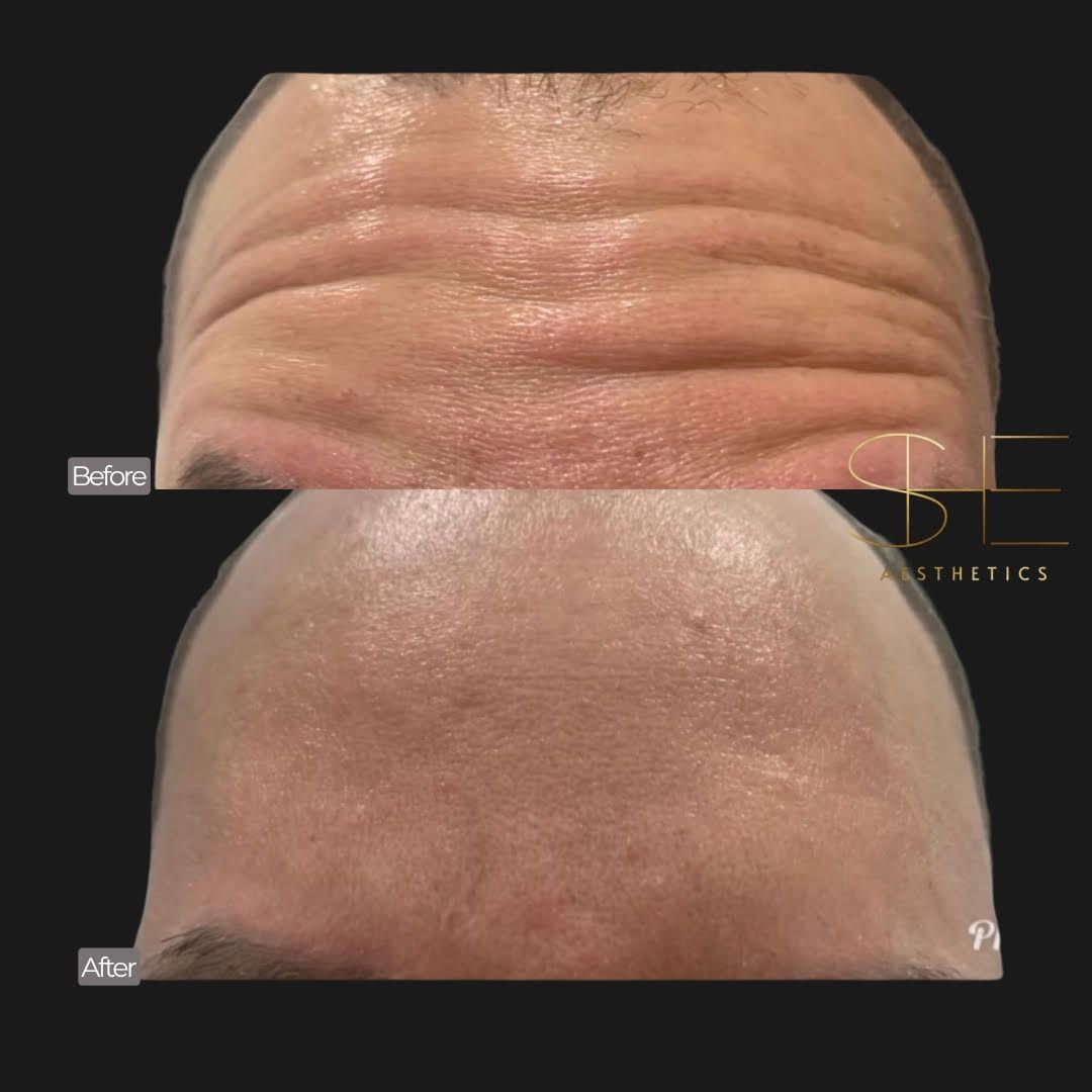 Smooth wrinkles with botox at she aesthetics in klein, spring, the woodlands, cypress tx Smooth wrinkles with botox at she aesthetics in klein, spring, the woodlands, cypress tx
