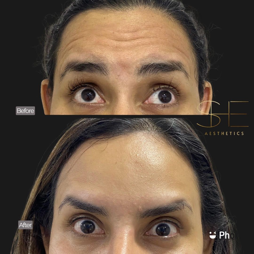 Smooth wrinkles with botox at she aesthetics in klein, spring, the woodlands, cypress tx Smooth wrinkles with botox at she aesthetics in klein, spring, the woodlands, cypress tx
