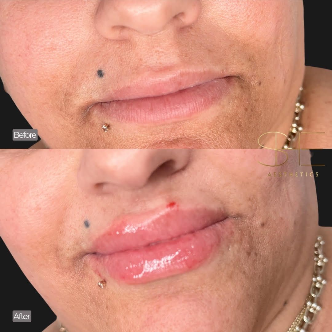 Amazing natural looking lip filler results at she aesthetics in klein, spring, the woodlands, houston, cypress tx Amazing natural looking lip filler results at she aesthetics in klein, spring, the woodlands, houston, cypress tx