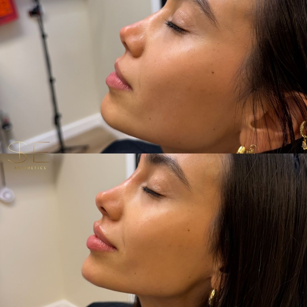 Natural facial balancing at she aesthetics in klein, spring, cypress, houston tx Natural facial balancing at she aesthetics in klein, spring, cypress, houston tx