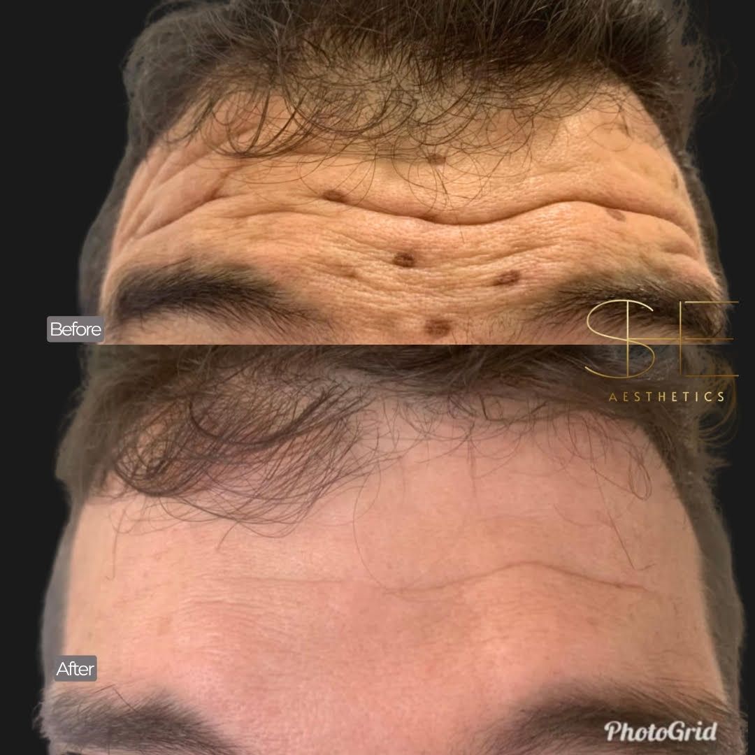 Smooth your wrinkles using botox at she aesthetics in klein, spring, the woodlands, cypress tx Smooth your wrinkles using botox at she aesthetics in klein, spring, the woodlands, cypress tx