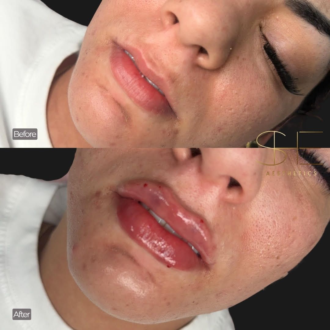 Amazing lip filler results at she aesthetics in klein, spring, cypress, tomball, houston tx Amazing lip filler results at she aesthetics in klein, spring, cypress, tomball, houston tx