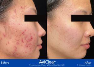 AviClear before and after