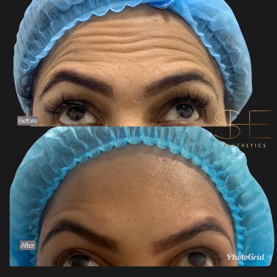 Smooth wrinkles with botox at she aesthetics in klein, spring, the woodlands, cypress tx Smooth wrinkles with botox at she aesthetics in klein, spring, the woodlands, cypress tx