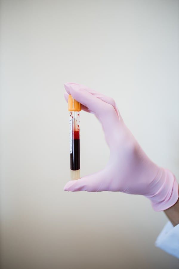 PRP/PRF Injections near me at she aesthetics medical spa in klein, spring, tomball, the woodlands, cypress, and houston tx. PRP can be used for joint rejuvenation, facials, hair restoration, and be used as filler